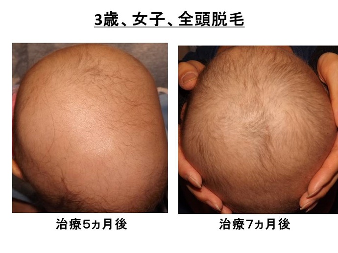 円形脱毛症　病院